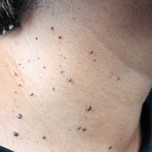 Skin Tag removal